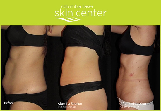 Columbia Laser Skin Center Coolsculpting Before And After Columbia Laser Skin Center