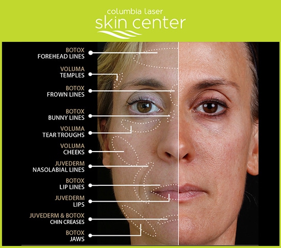 Columbia Laser Skin Center Botox Cosmetic Before And After Columbia Laser Skin Center